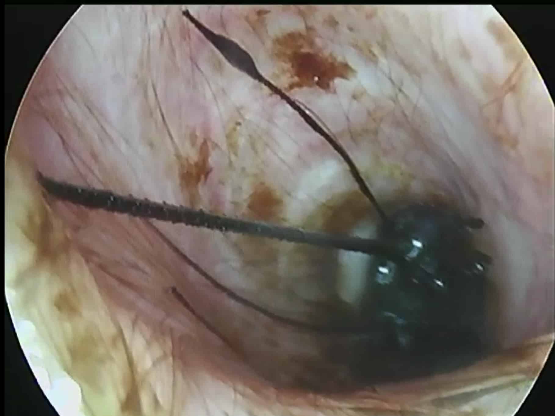 A mature plant awn — a grass seed husk with backward-facing barbed bristles — deep in the ear canal in front of the eardrum. The dark barbs in the image grip the husk, which faces the eardrum, and drive it deeper into the ear canal with every movement.