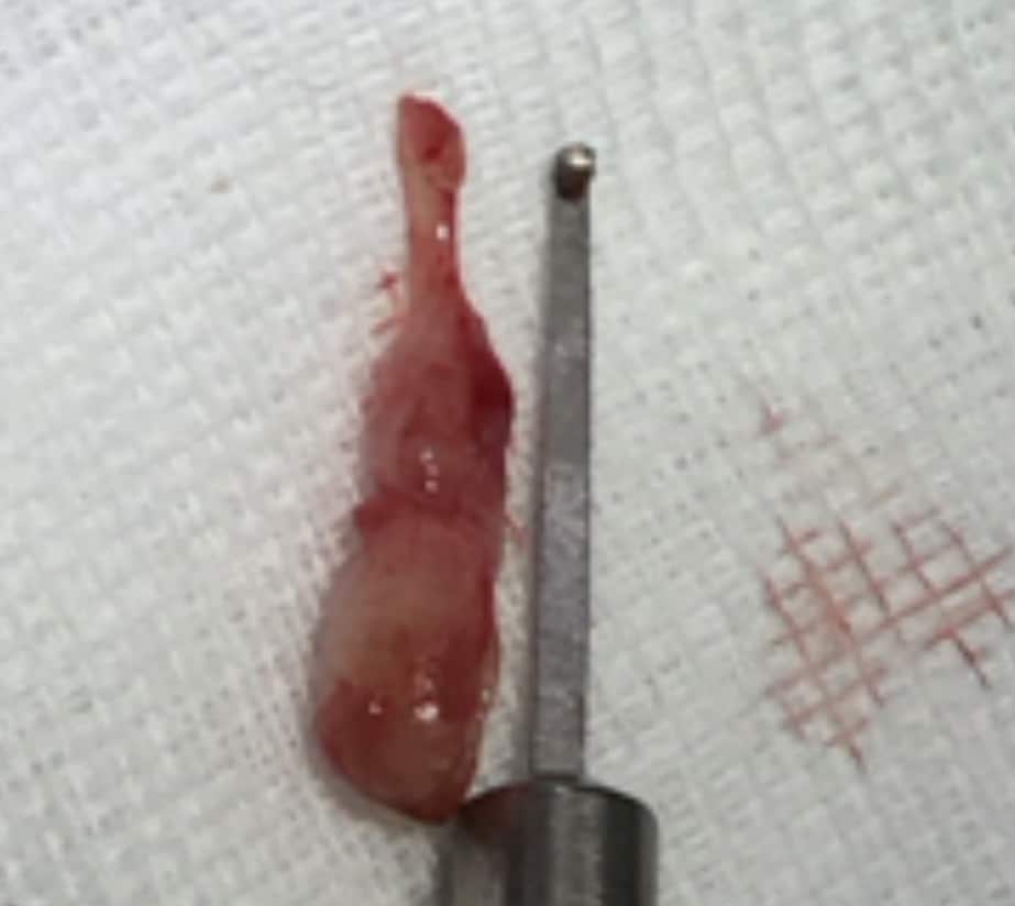 Removed ear polyp, 2.5 cm long, from the young Maine Coon cat