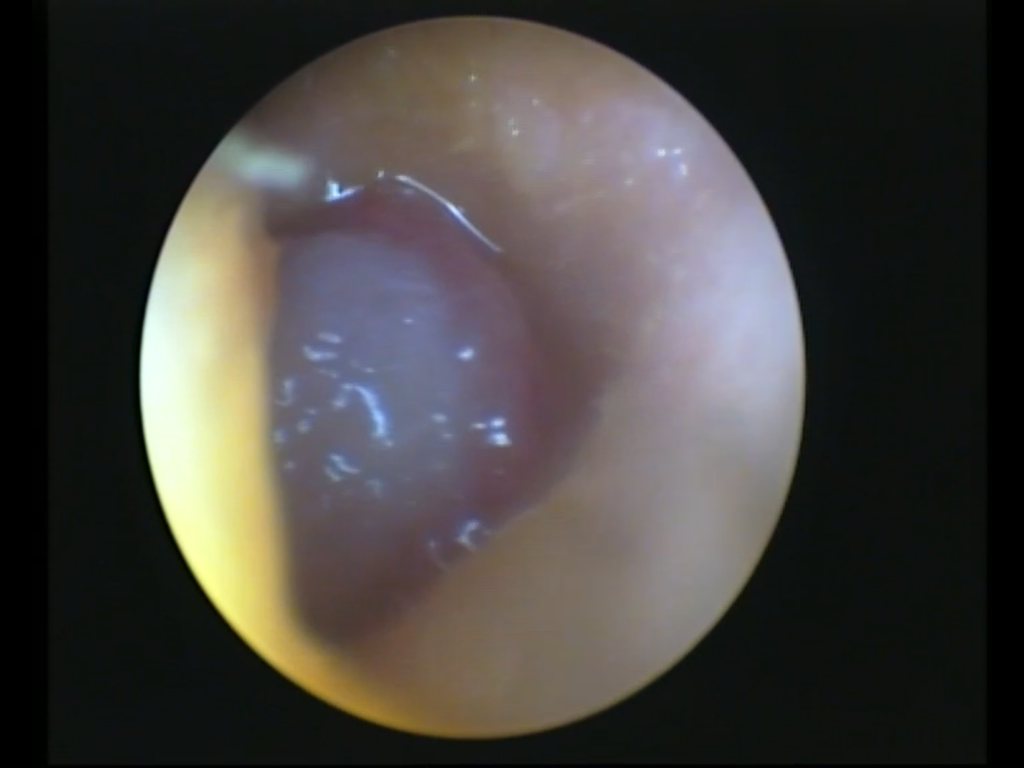 Polyp in the ear canal of a young Maine Coon cat