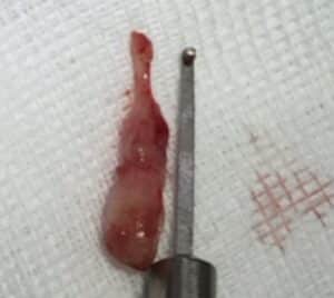 Entfernter Ohrpolyp von 2,5 cm Länge bei der jungen Maine Coon Katze